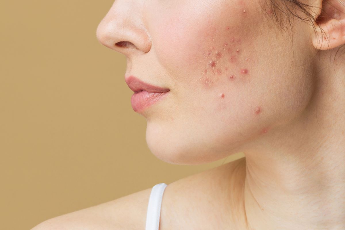 Skin rashes